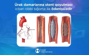 Ürək damarlarına stent qoyulması İTS ilə ödənişsizdir